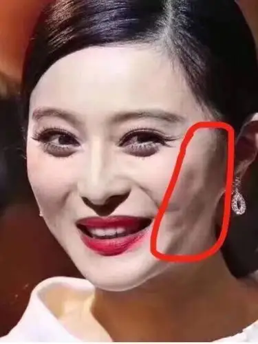 那些做了线雕失败的明星!司王菲,那英手_圈子-新氧美容整形