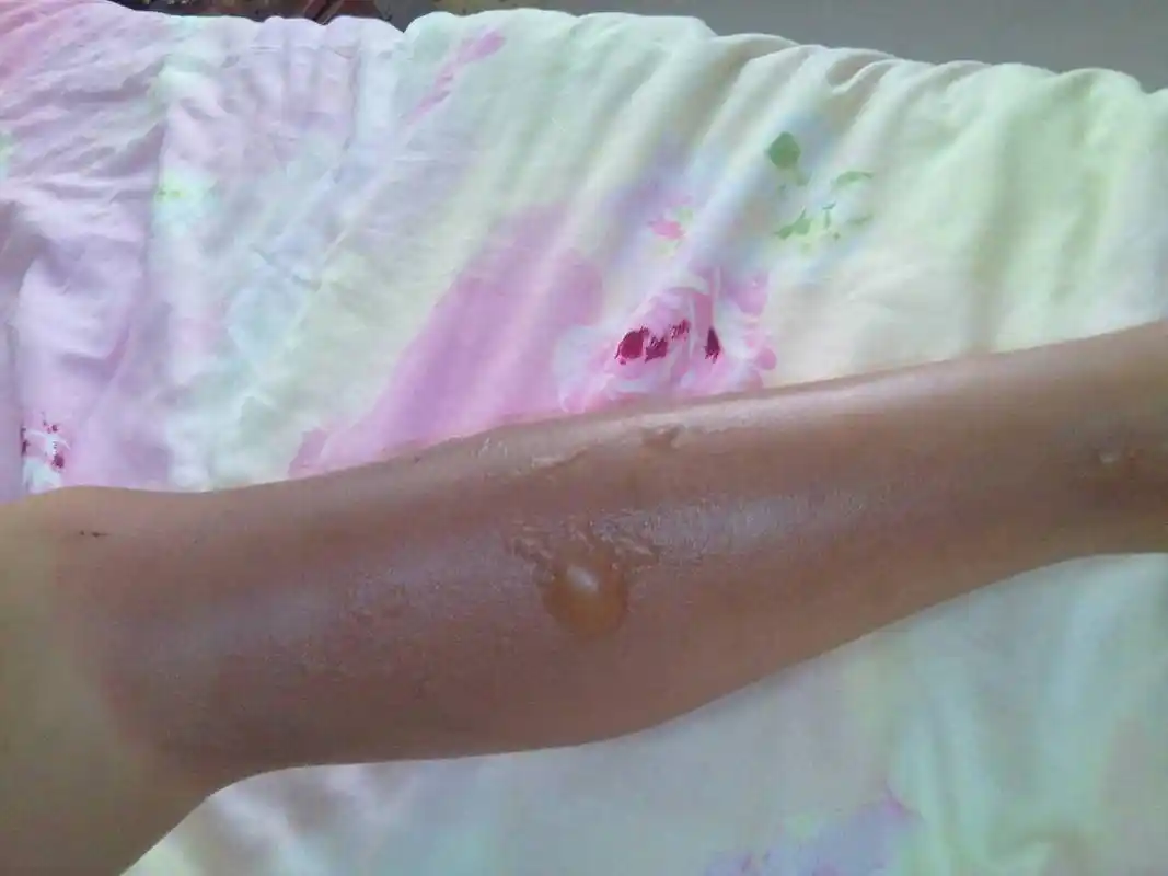 问:女儿被烫伤了,整条腿都变黑了.起了水泡.