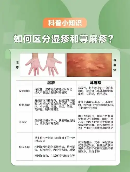 如何区分湿疹和荨麻疹