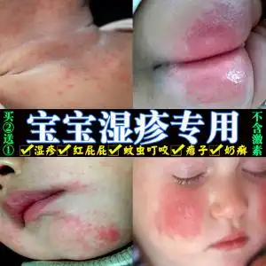 宝宝湿疹膏婴儿止痒药膏宝宝皮肤瘙痒红屁屁红疹湿疹儿童痱子膏