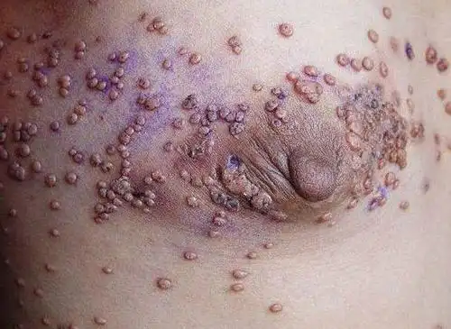 艾滋病什么症状最明显 艾滋病什么症状最明显图片