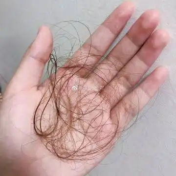 脱发怎么办#天啊 脱发女生上线 照这样下去30岁前就要秃了 这可咋整