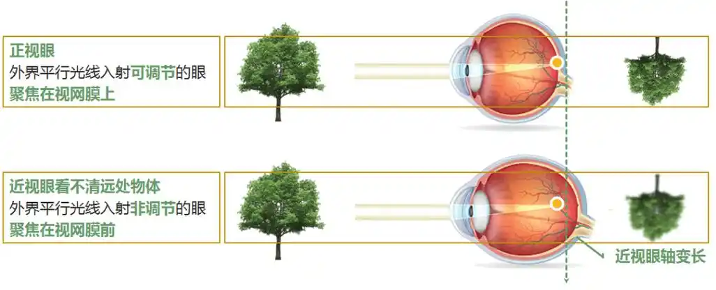 为什么眯眼有如此神奇的力量?这得从近视的原理说起.