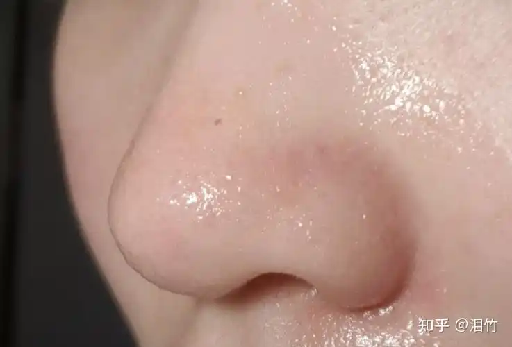 怎么去鼻子的黑头? - 知乎