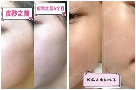 上海皮秒激光祛斑好医院盘点,附九院皮肤科祛斑收费价格表