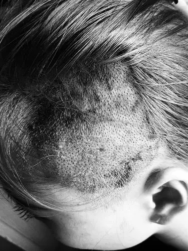 海口19岁少女染发被烧伤