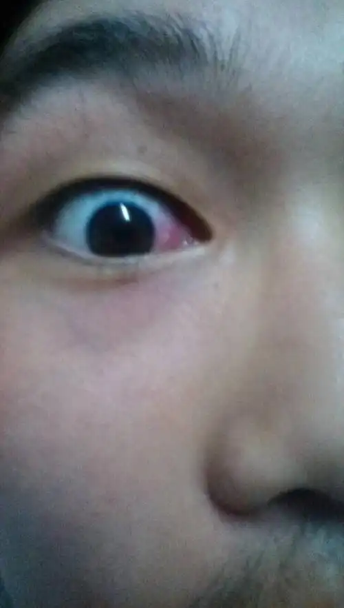 求助,我现在心情很难过, 昨天眼睛有点血丝,今天早上发现血丝变红得更