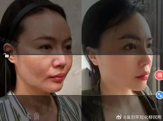 "    【39岁广州顾客"面部提升 颈部提升 脂肪填充"一年3个月分享】