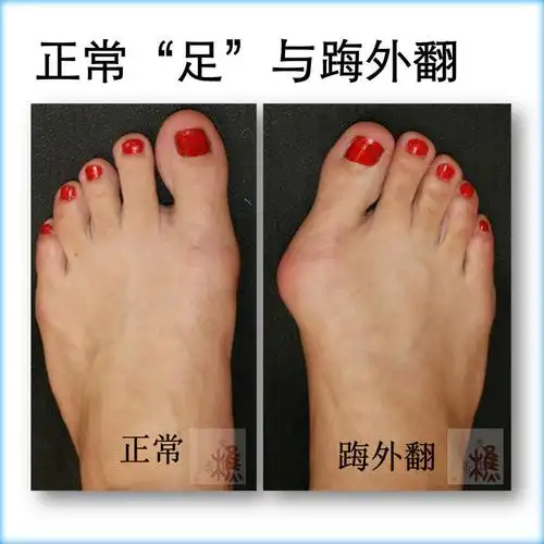 让丑脚丫变成美足踇外翻能否微创治疗