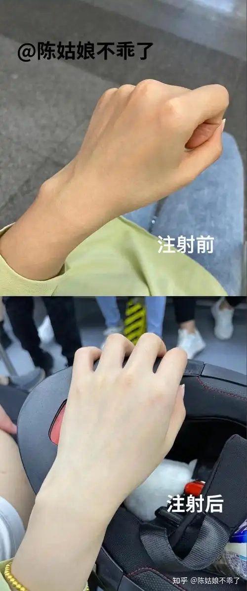 不能说毫无效果,只是太慢了而且也不容易那么坚持,美白针真的是唯一能