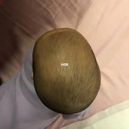 宝宝三个多月快四个月了,这是什么头型?要怎么睡圆头?