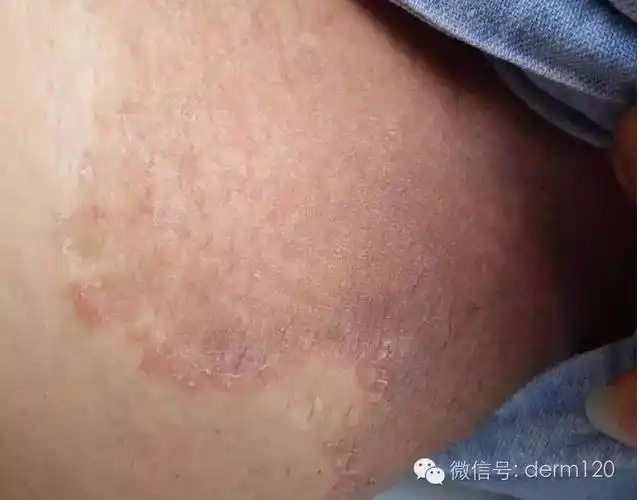 大腿根容易潮湿红肿瘙痒脱皮,得了股癣,怎么办呢?