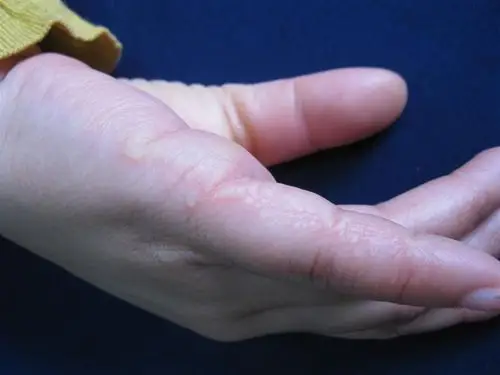 看图识病---------播散性掌跖角化病