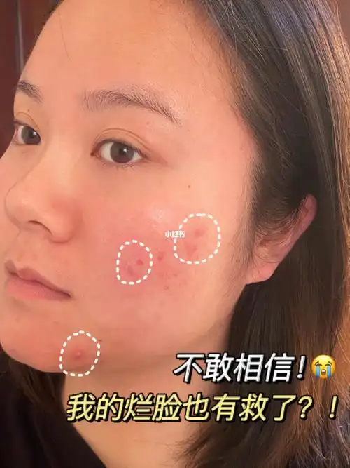 姨妈痘熬夜痘无处遁形!01没啥痘能留过3天!