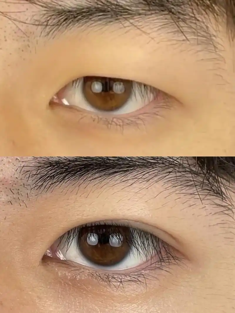 【男生做双眼皮的五点好处】 想从那男的变成帅哥?