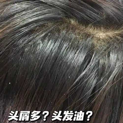 头皮问题产生原因如下:头皮屑,头痒和毛囊炎是头皮健康问题,其采