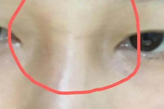 山根有横纹的女人面相婚姻运势受阻碍健康状况受威胁