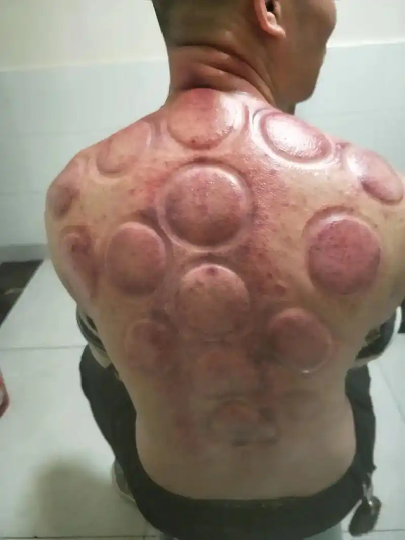 刮痧时各部位所出现的痧是渗出于血脉之外存在于组织之间皮肤之下的