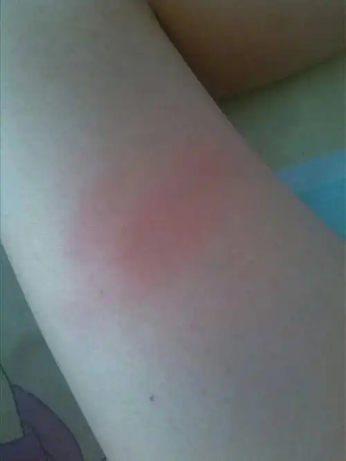 腿被开水烫着,过了两天了,开始就用冷水冲了有用盐敷过了现在还是红着