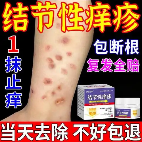 结节性痒疹特效治顽固硬疙瘩小腿红斑瘙痒皮炎湿疹皮肤病止痒药膏