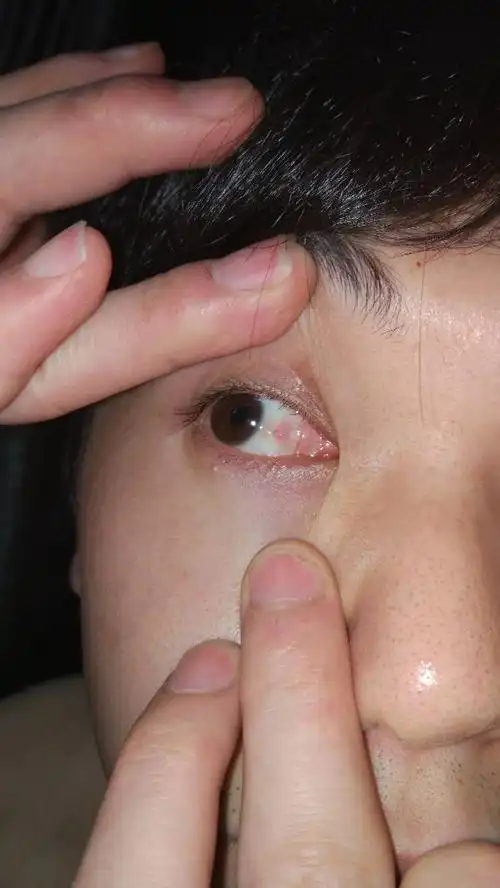 眼球长了个脓包似的小包,我想问下这对眼睛有影响吗?