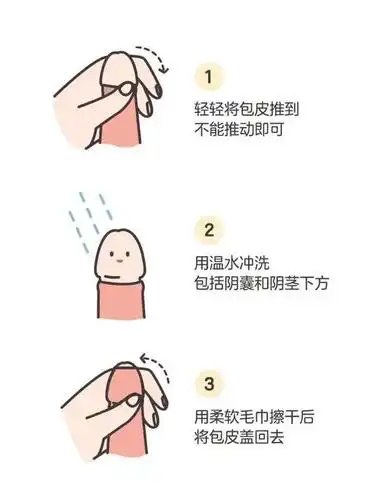 暑假割包皮正当时,杭州复旦儿童医院解开男宝宝的「小丁丁」隐藏的