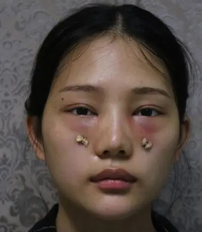 美然鼓起勇气去掉眼袋泪沟15天后竟