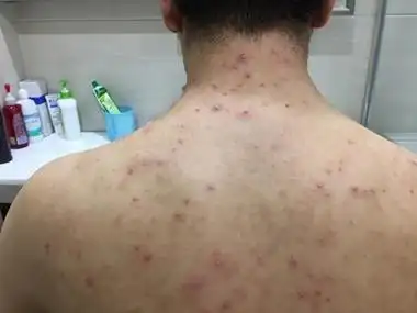 成人脂溢性皮炎后背很多红色疙瘩图