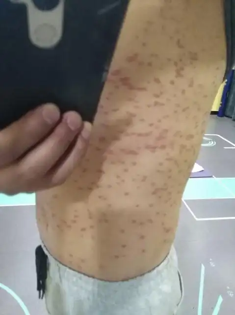 初期牛皮癣图片早期