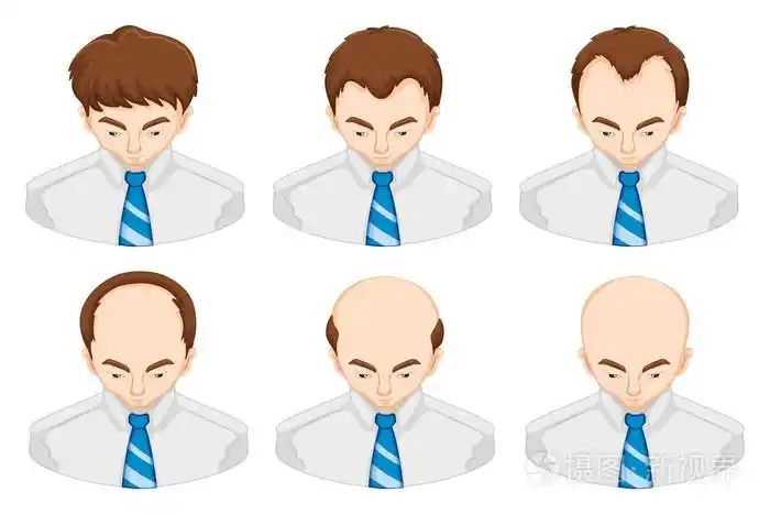 男人脱发的阶段