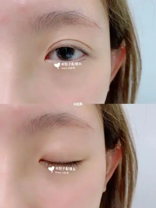 埋线双眼皮三个月的样子