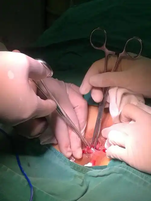 痔上粘膜环切吻合术 混合痔外切内扎术