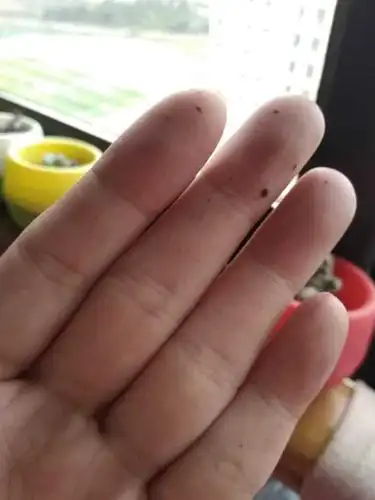 手指突然间长出一个痣 会不会变成黑色素瘤 实验室经常接触些生化物品