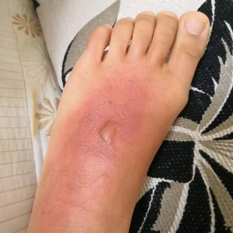 孩子被100度开水烫伤,妈妈一小时五字处理,医生:有文化