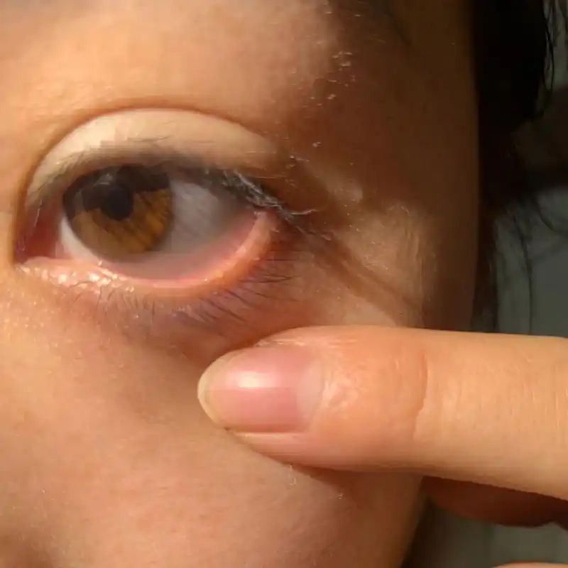 下眼睑经常长水泡是什么原因 连着长了3个,中间一个大的,两边各一个小