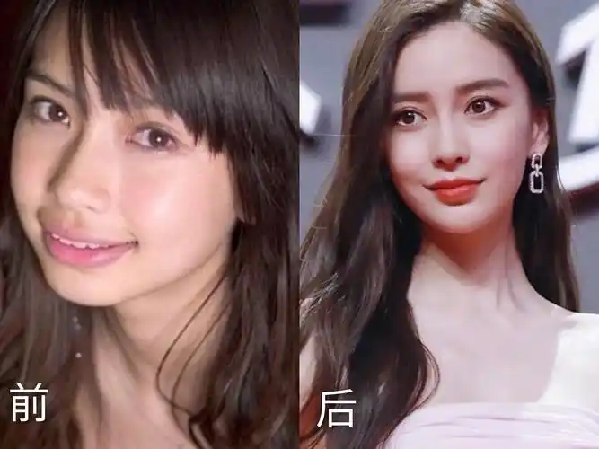 众多明星整牙后纷纷变好看,但我30岁了,还能做牙齿矫正吗?