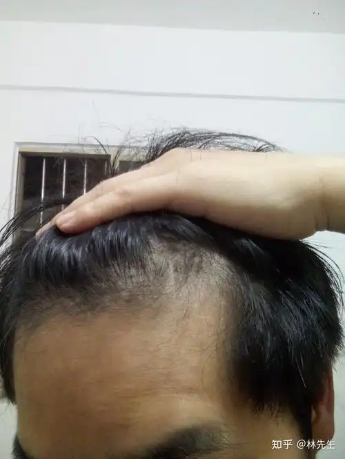 治疗m型脱发用米诺加非那第二个月