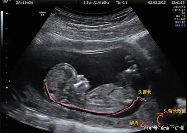 怀孕13周胎儿头臀长69mm正常吗?告诉你一个公式