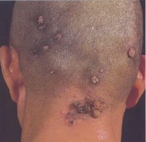 寻常疣头部母疣图片