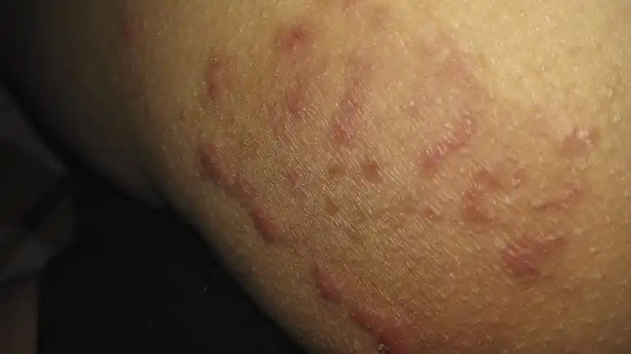 屁股上这个是什么?怎么引起的?如何解决