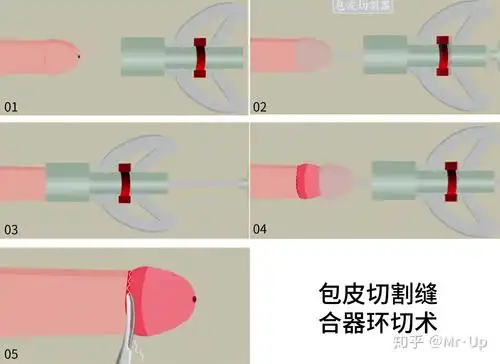 包皮过长包茎割还是不割