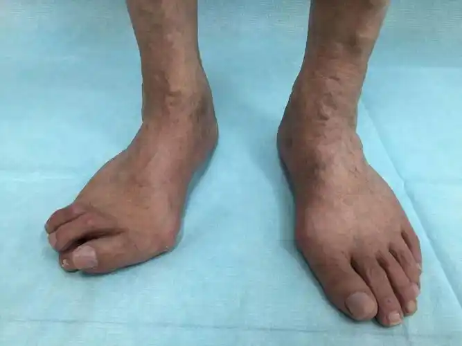 茶陵男子惊现三根脚趾"苦命脚"