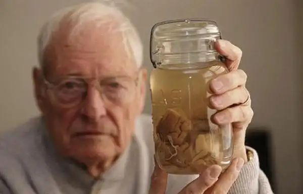 美博物馆独家收藏爱因斯坦大脑切片 曾被偷走