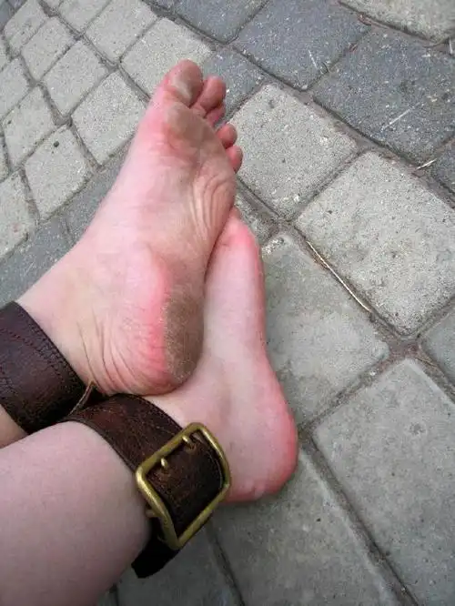 我今年24岁,是个女孩,小时候上初中打开水时脚被烫了,结果医生和我说