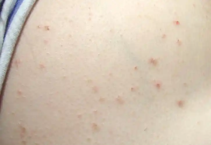 不同而细分的一种类型,好发于急性链球菌感染后,多为儿童和青年发病