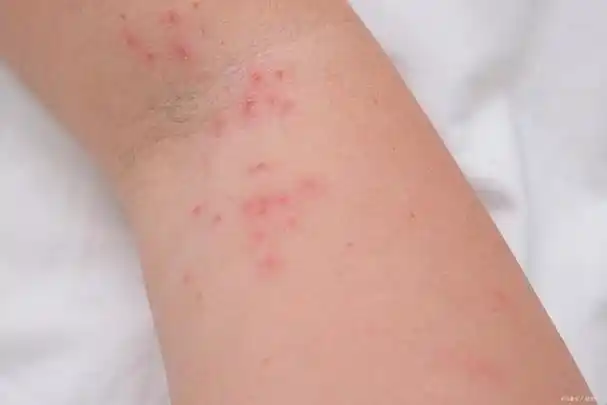 汗液中的盐分,尿素等物质或者细菌代谢产物可能会刺激皮肤,引起瘙痒感