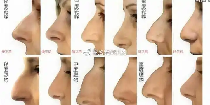 驼峰鼻到底是好看还是不好