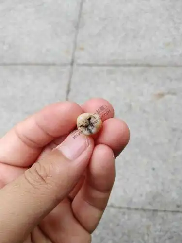 (有图,不血腥)上牙智齿轻松拔掉第一颗