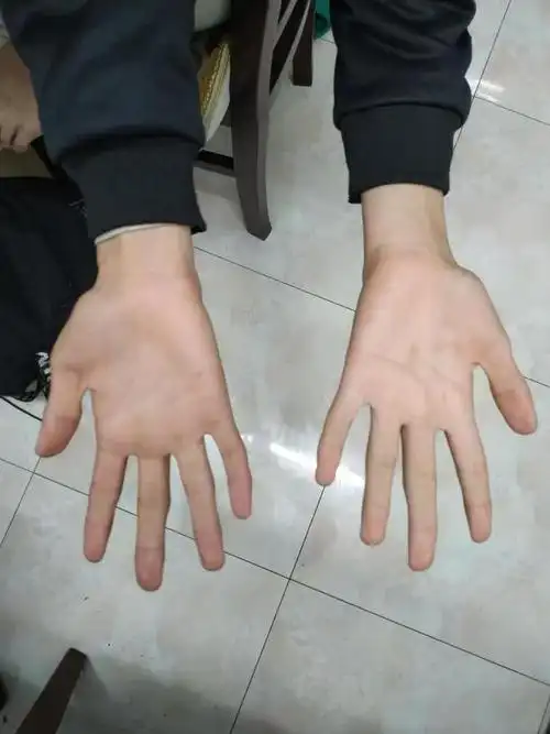 印度花季女孩因车祸双臂截肢移植黑人手臂后肤色发生改变