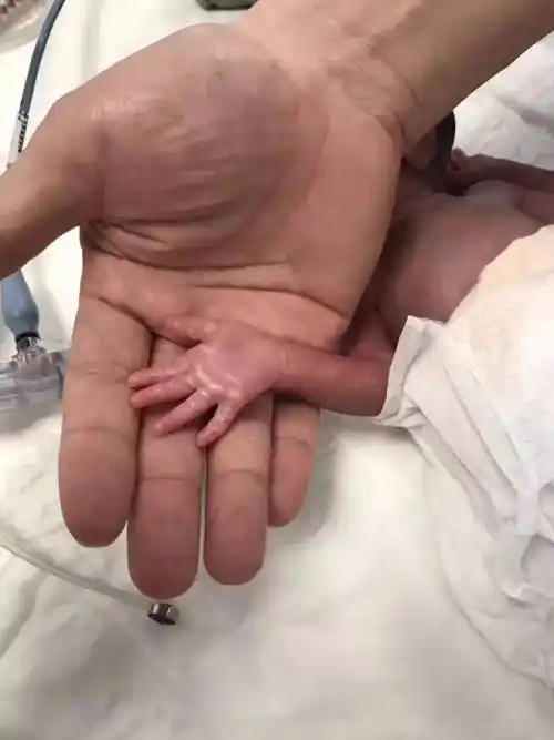 他胎龄仅26周,体重仅900克,我们为他接力生命